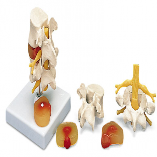 2節腰椎帶2個病變椎間盤模型