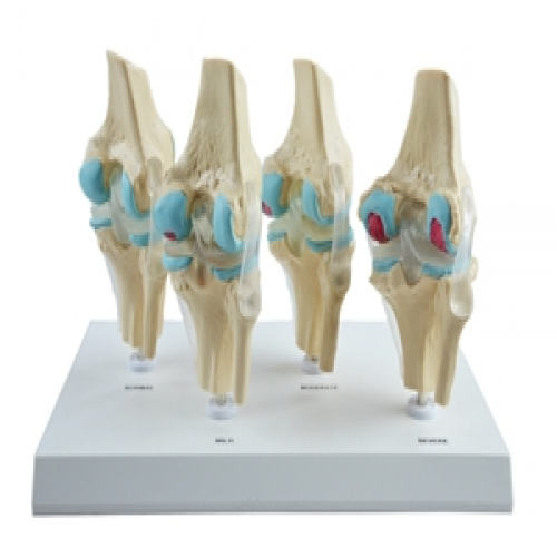 4階段病變膝關節模型